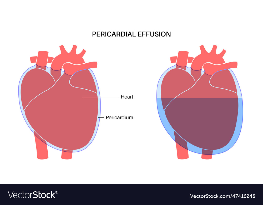 Pericardial effusion heart Royalty Free Vector Image