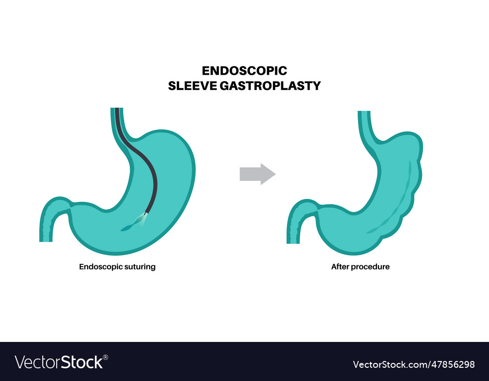 Endoscopic sleeve gastroplasty Royalty Free Vector Image