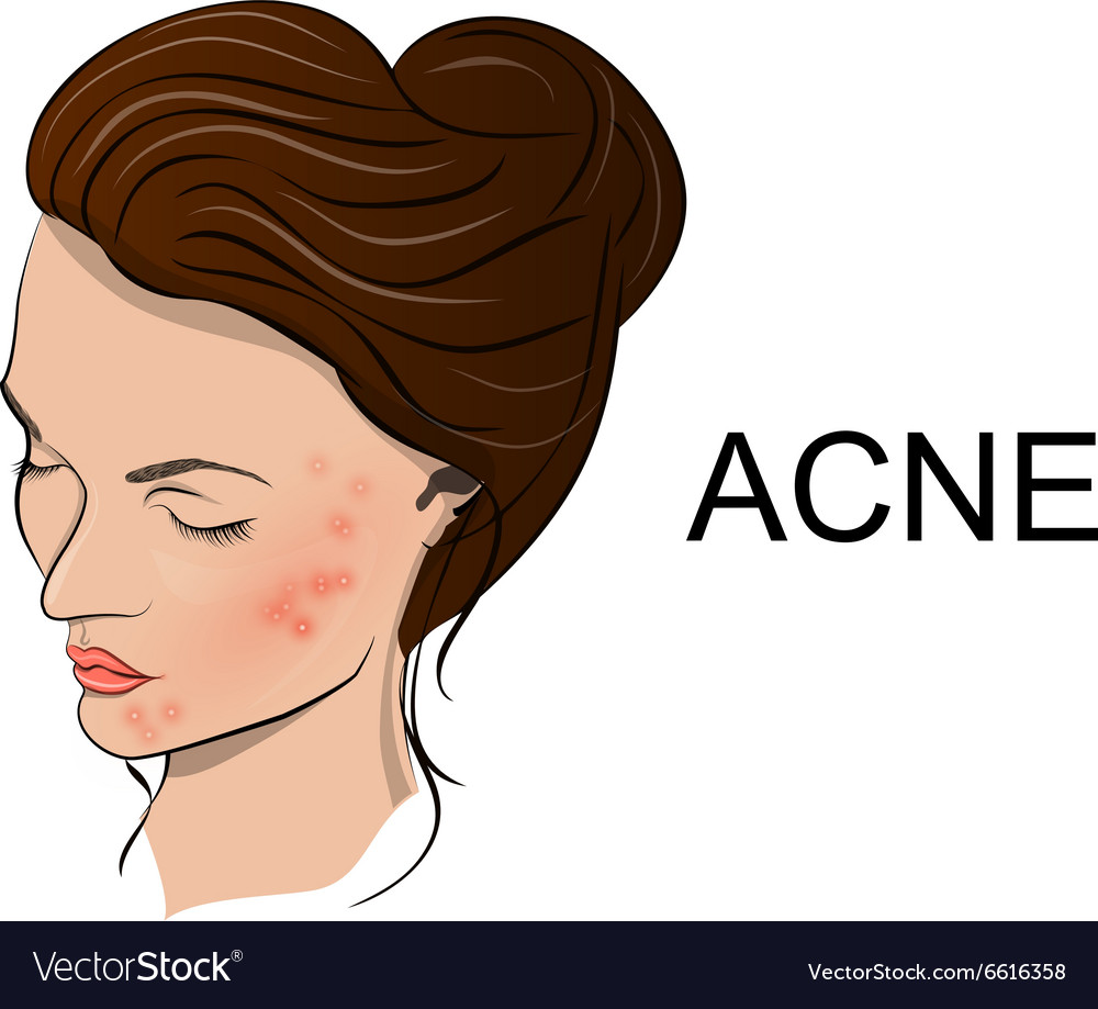 Acne Royalty Free Vector Image Vectorstock