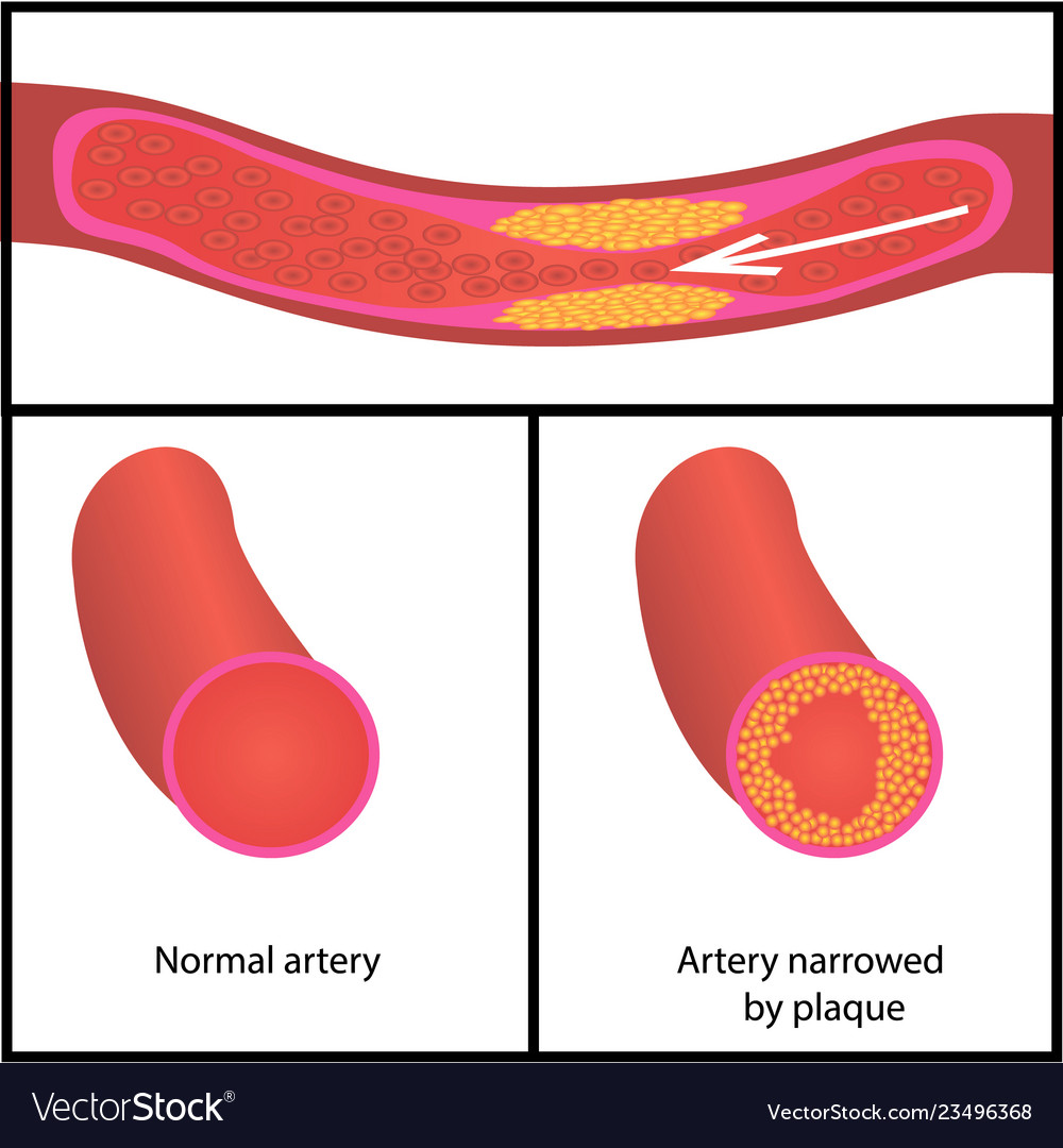 Levels cholesterol plaque in vessels Royalty Free Vector