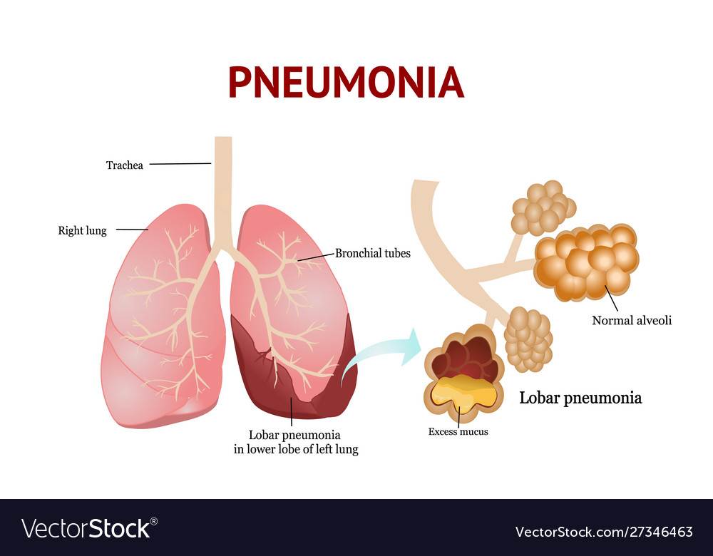 Pneumonia lobar isolated on white