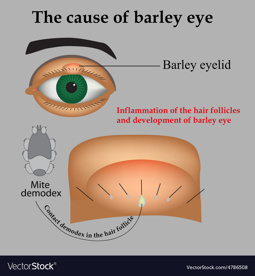 Diseases Of The Eye Barley Causes Of Barley Vector Image 7411