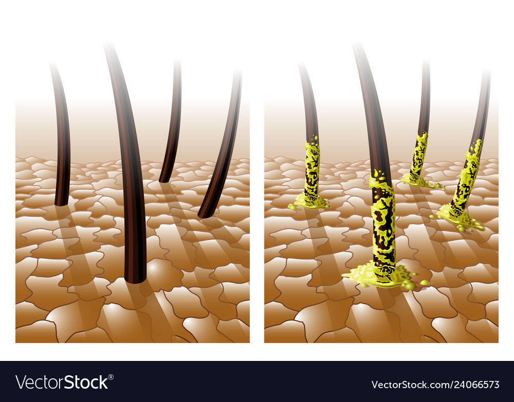 Normal And Greasy Hair Royalty Free Vector Image
