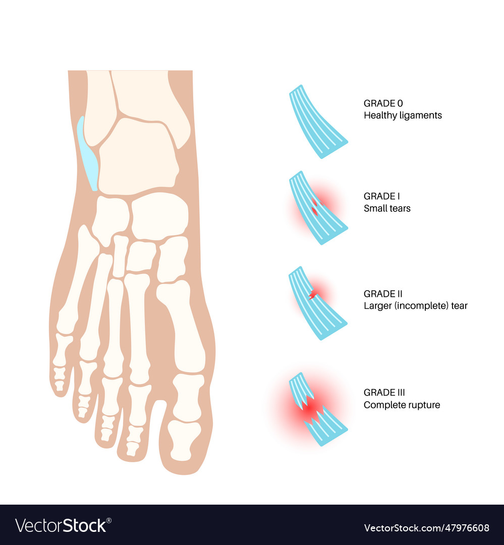 Sprained ankle injury Royalty Free Vector Image