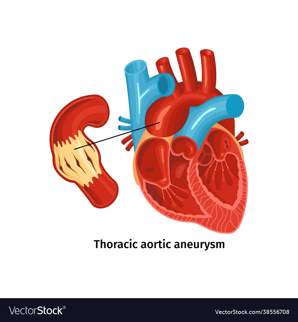 Heart disease anatomy poster Royalty Free Vector Image