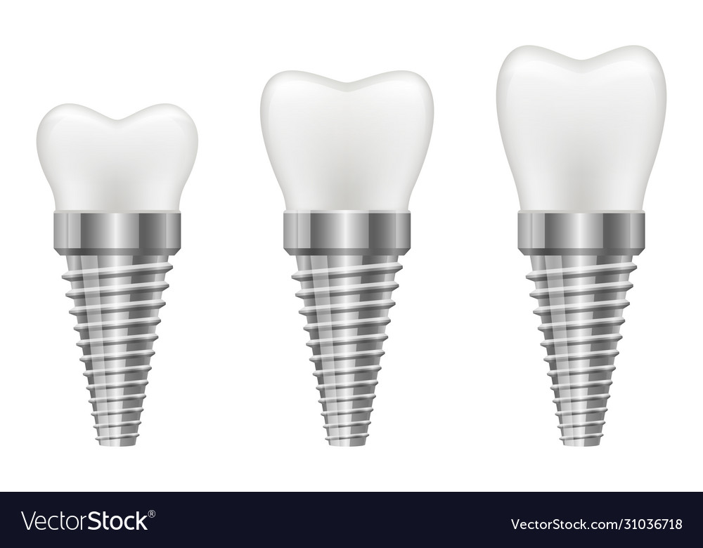 Tooth implant Royalty Free Vector Image - VectorStock