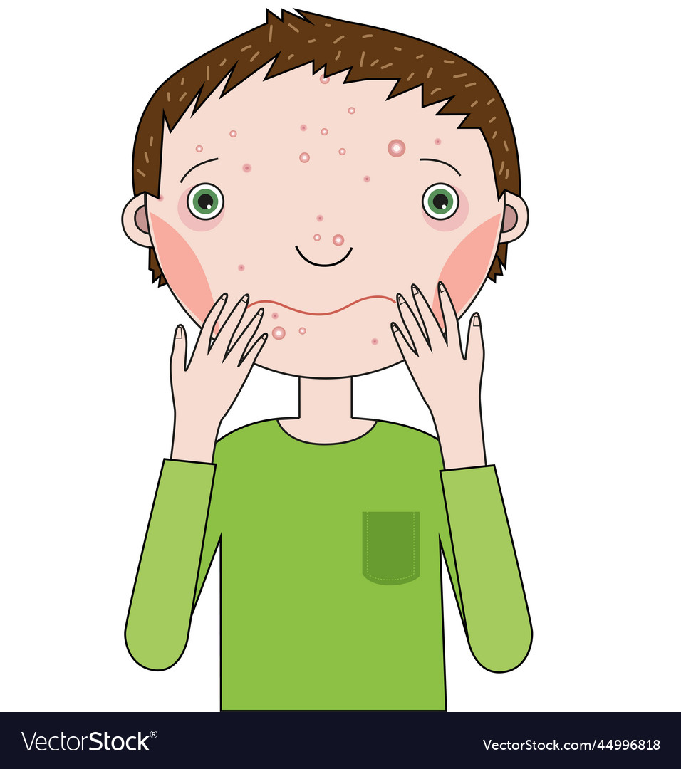 A guy with face on which pimples