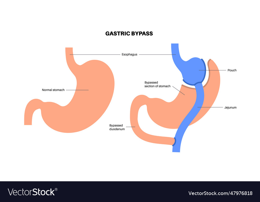 Gastric bypass surgery Royalty Free Vector Image