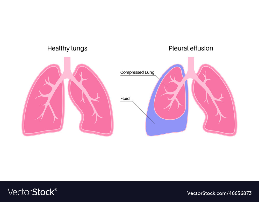 Pleural effusion poster Royalty Free Vector Image