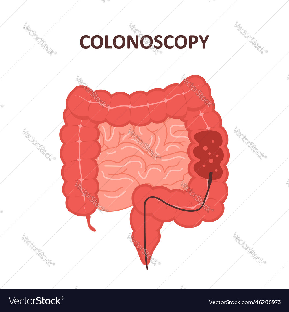 Colonoscopy procedure intestine exam