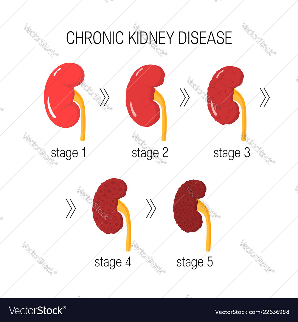 Chronic kidney disease Royalty Free Vector Image