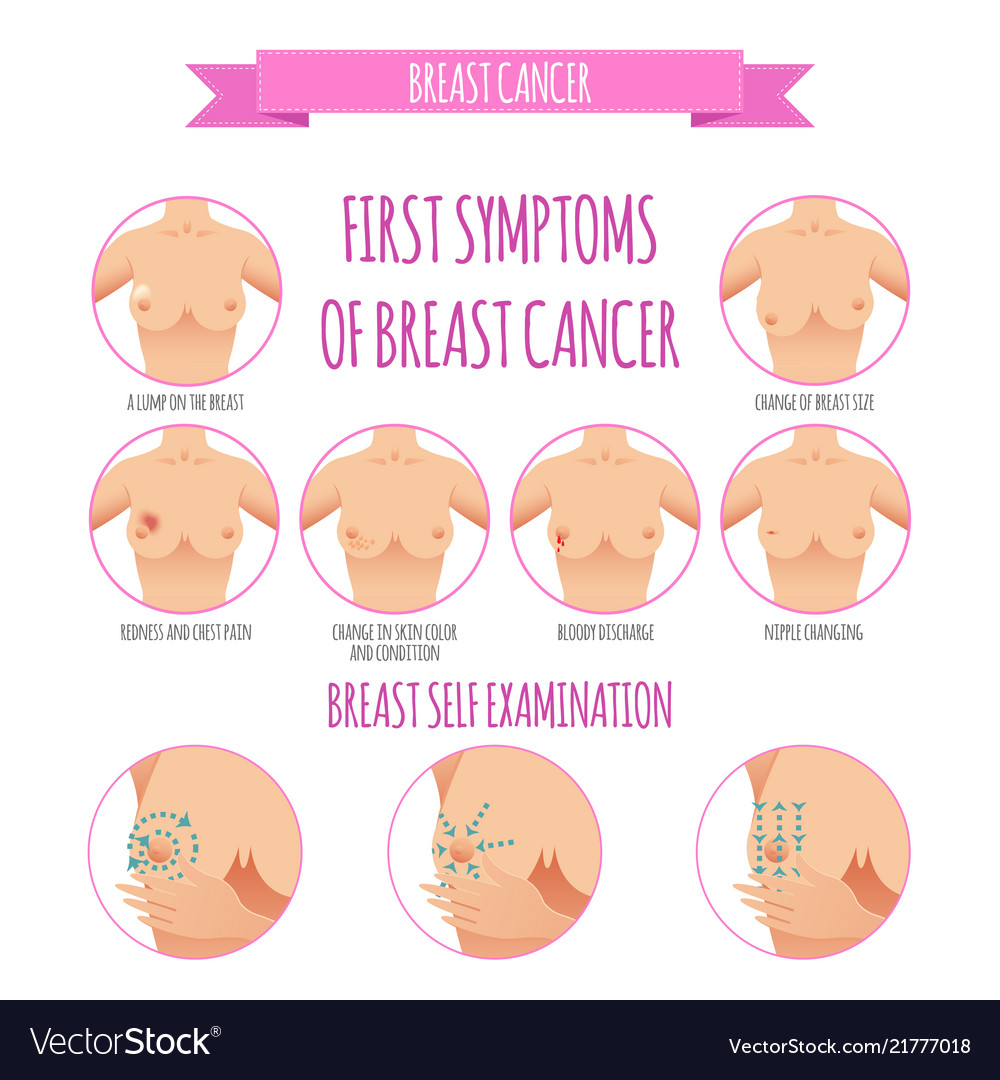 симптомы рака груди у женщин признаки и симптомы фото 119