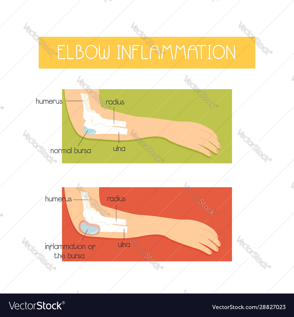 Poster with an elbow inflammation injuries concept