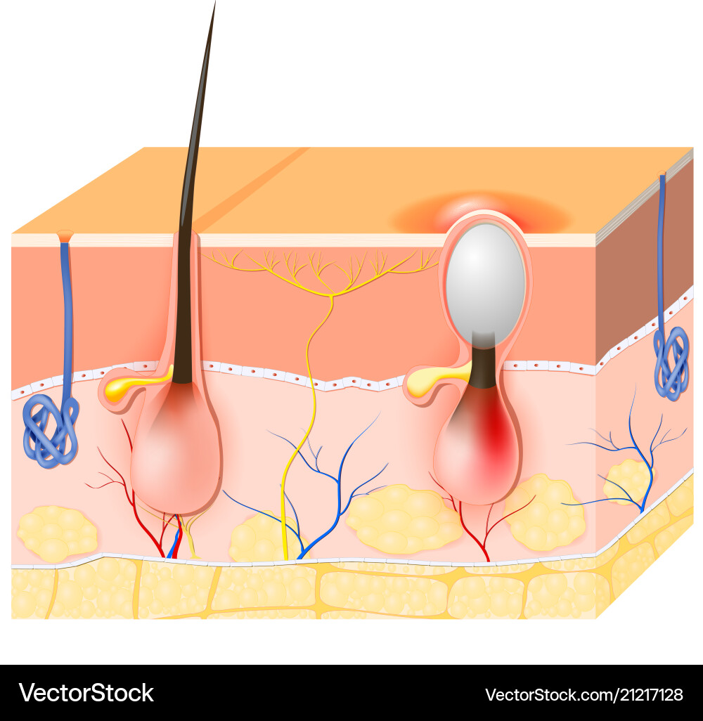 Acne Royalty Free Vector Image - VectorStock