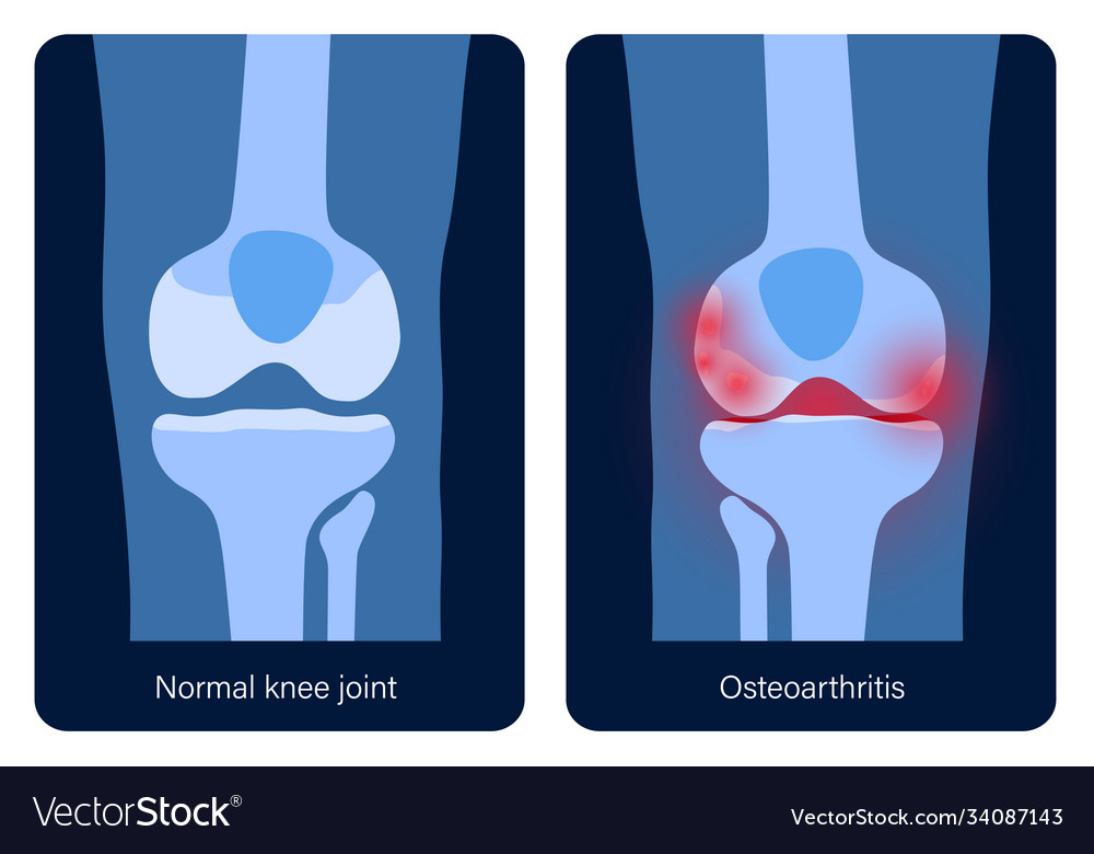 Arthritis in knee joint Royalty Free Vector Image