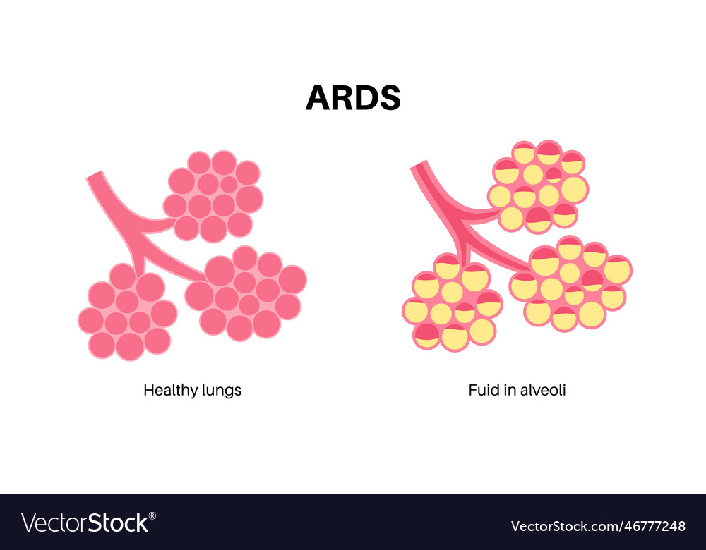 Ards anatomical poster Royalty Free Vector Image