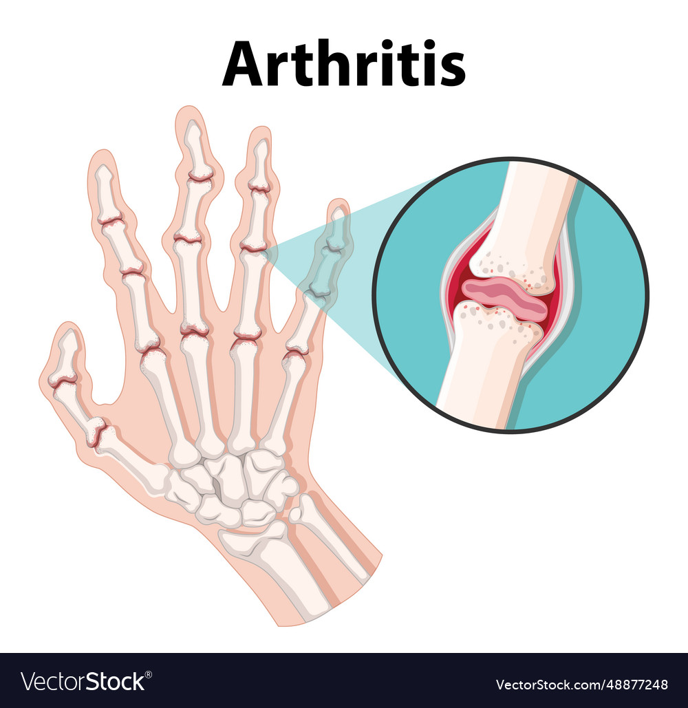 Science education human anatomy and arthritis Vector Image