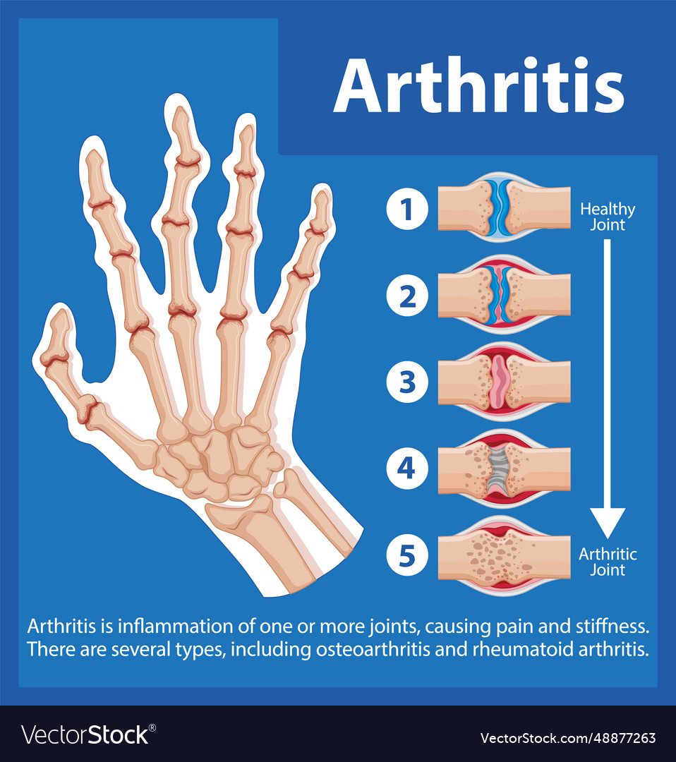 Science education of human anatomy arthritis Vector Image