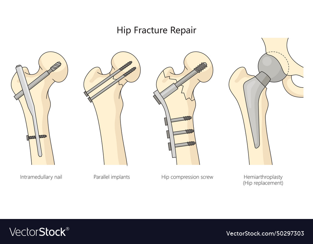 Hip fracture treatment diagram medical science Vector Image