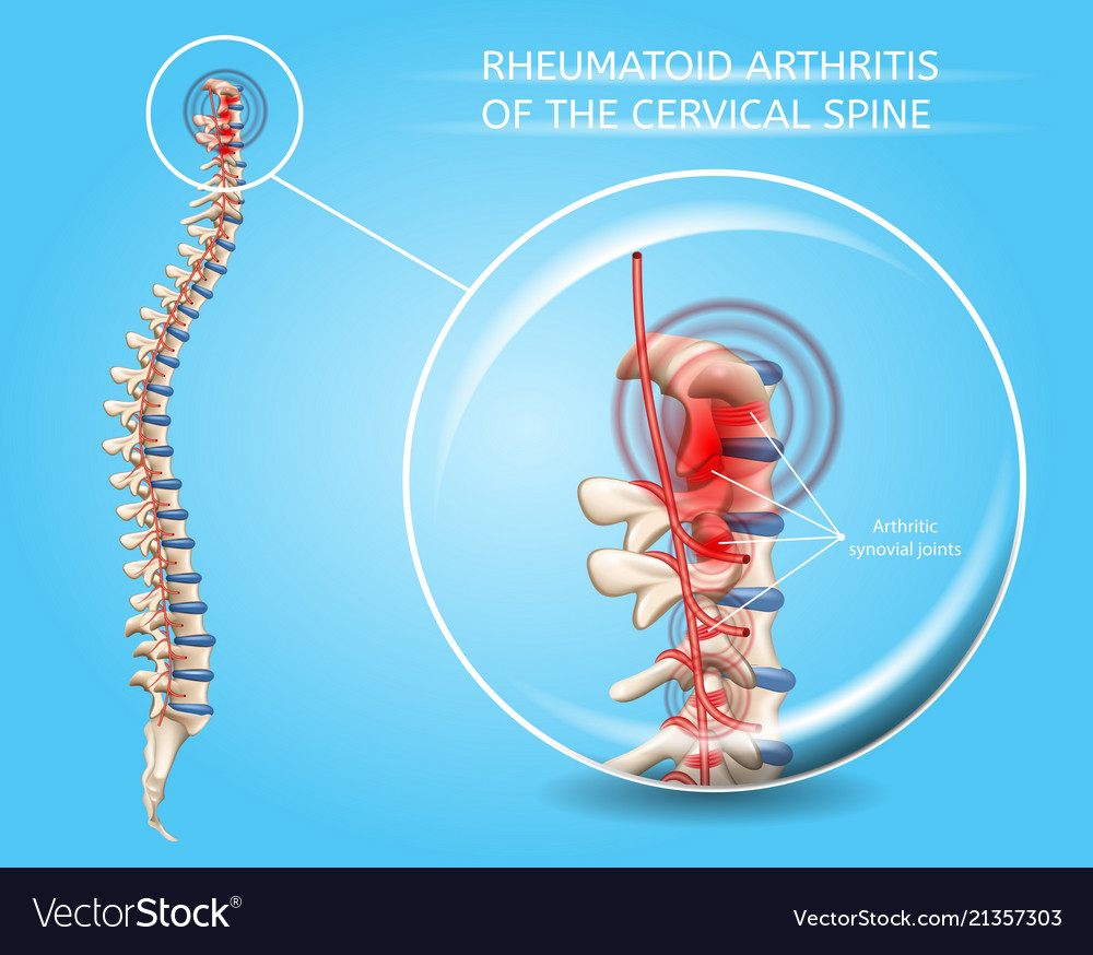 Rheumatoid arthritis cervical spine Royalty Free Vector