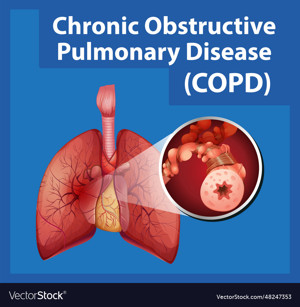 Science education of human anatomy copd Royalty Free Vector