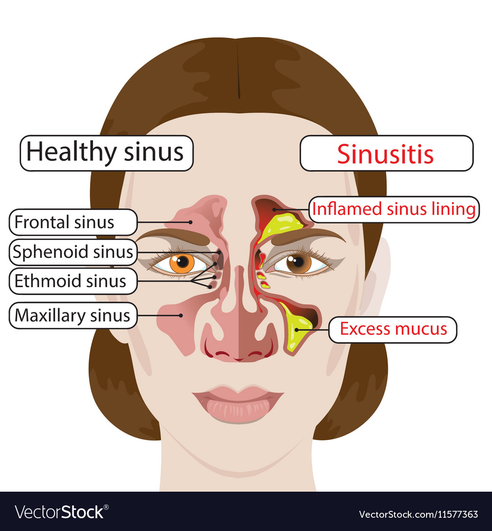 Sinusitis Royalty Free Vector Image Vectorstock