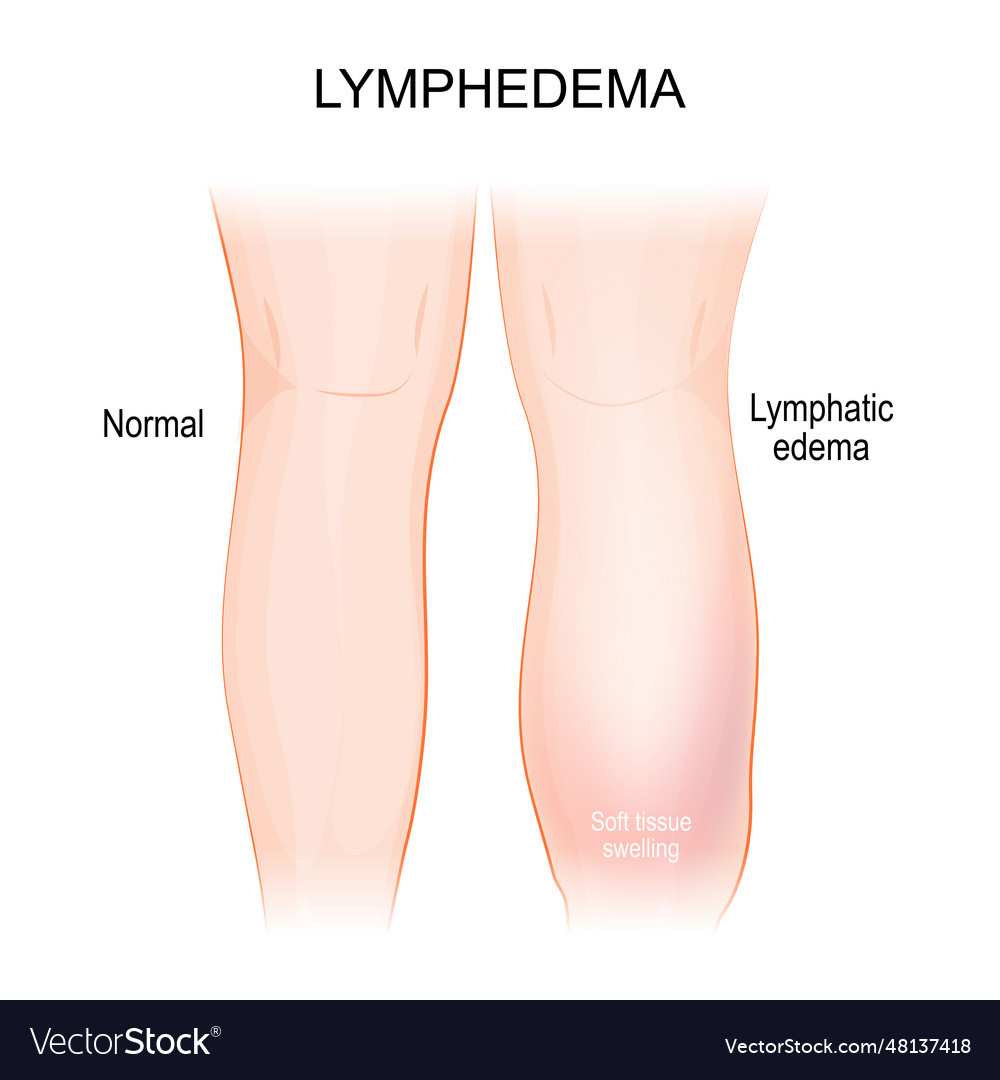 Lymphedema Lymphoedema Healthy Leg And Royalty Free Vector