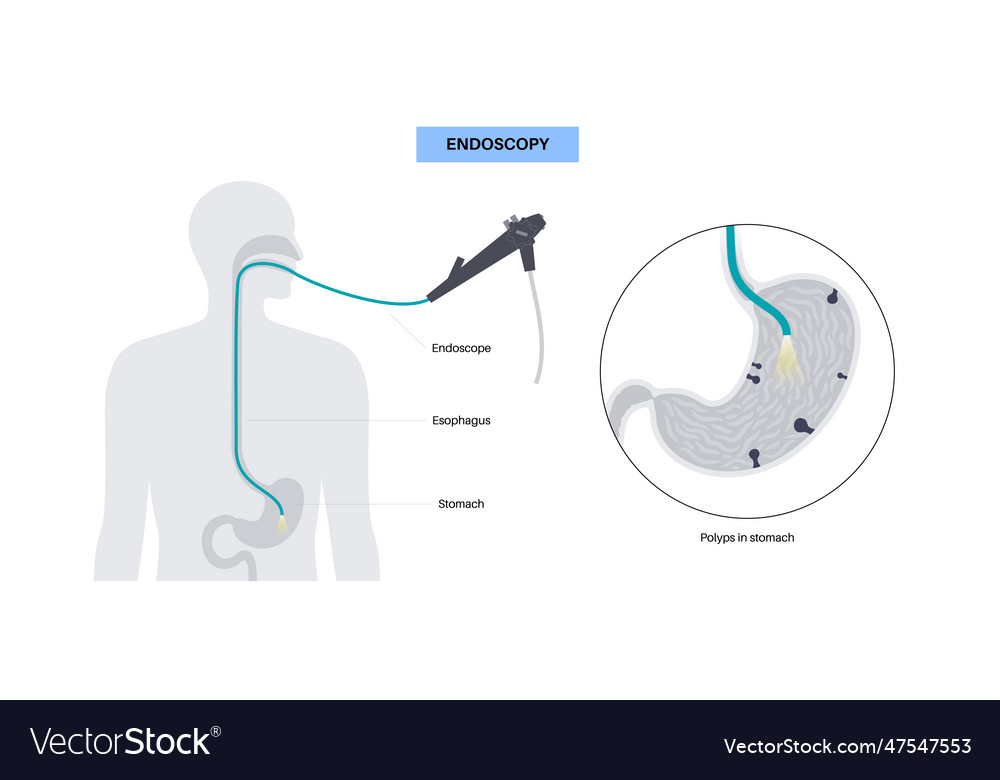 Gastroscopy Endoscopy Procedure Royalty Free Vector Image