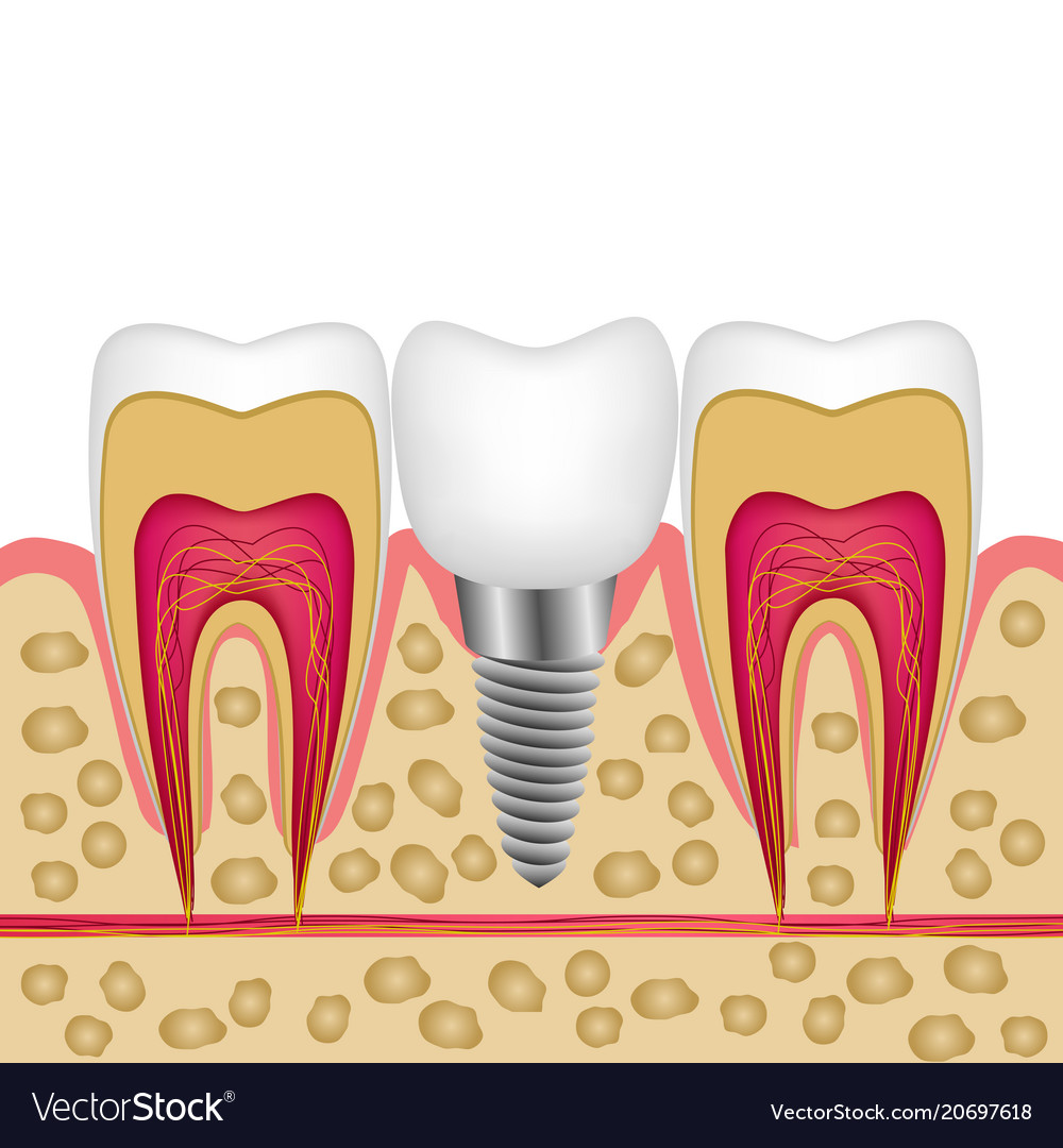 A Dental Implant In Bone Between Teeth For Vector Image