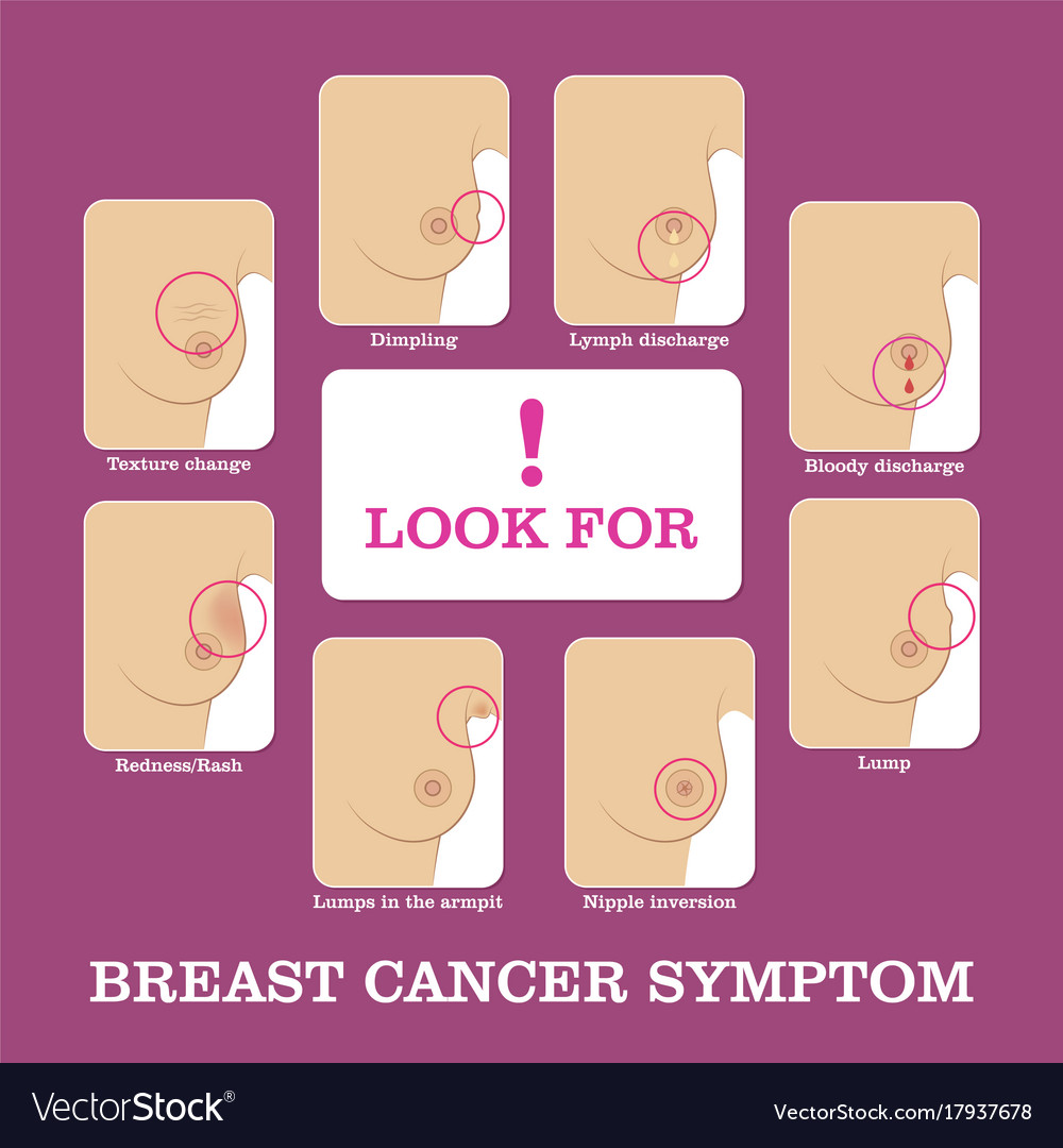 Symptoms of breast cancer