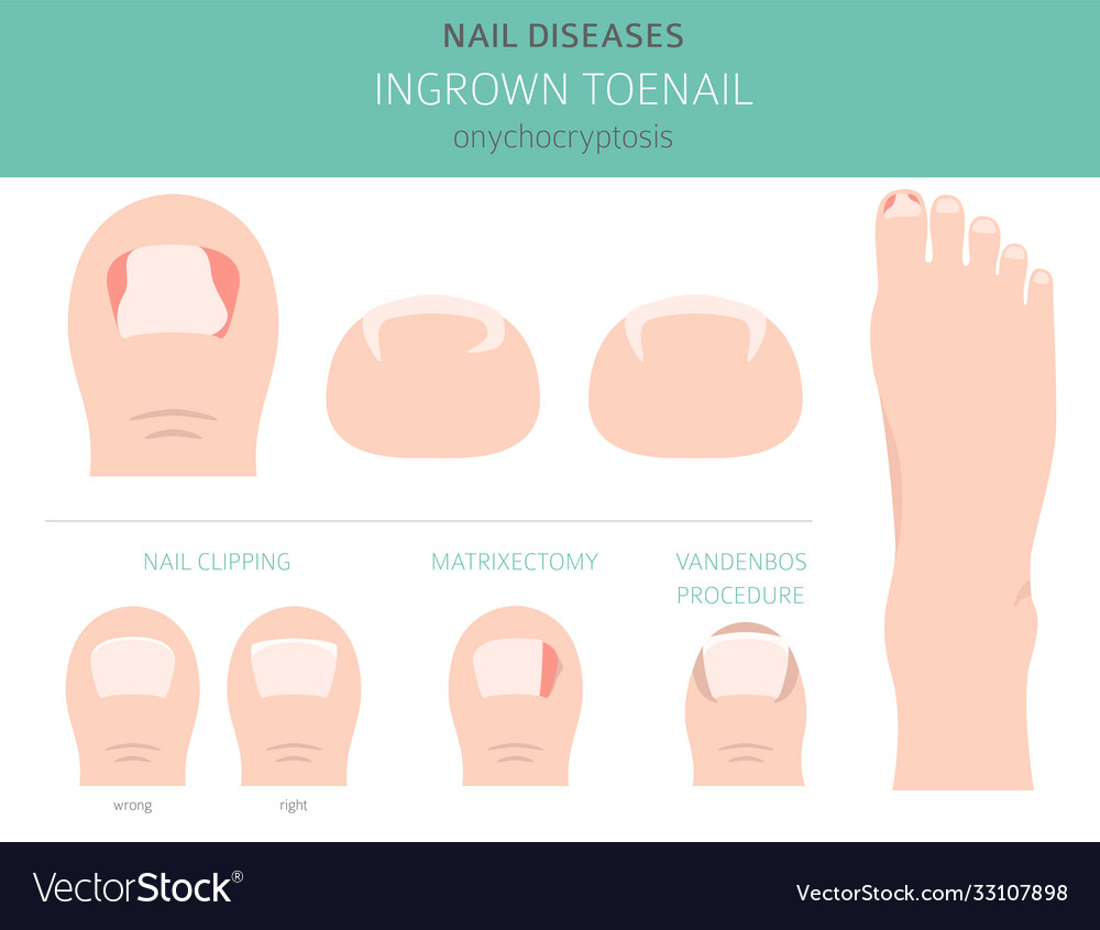 Nail diseases onychocryptocosis ingrown toenail Vector Image