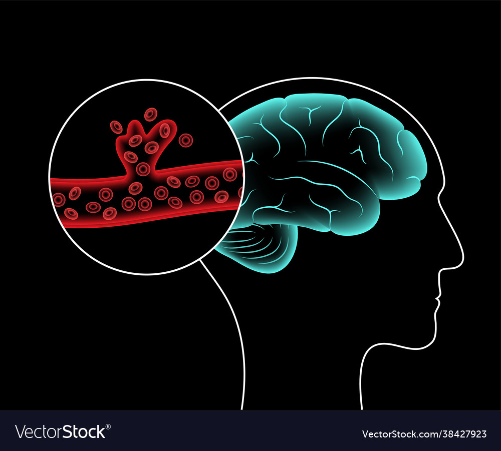 Hämorrhagic Stroke - Gehirnblutung