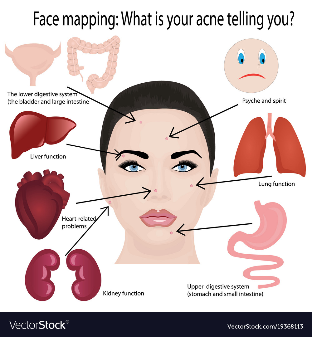 Face mapping what acne telling you info-graphic