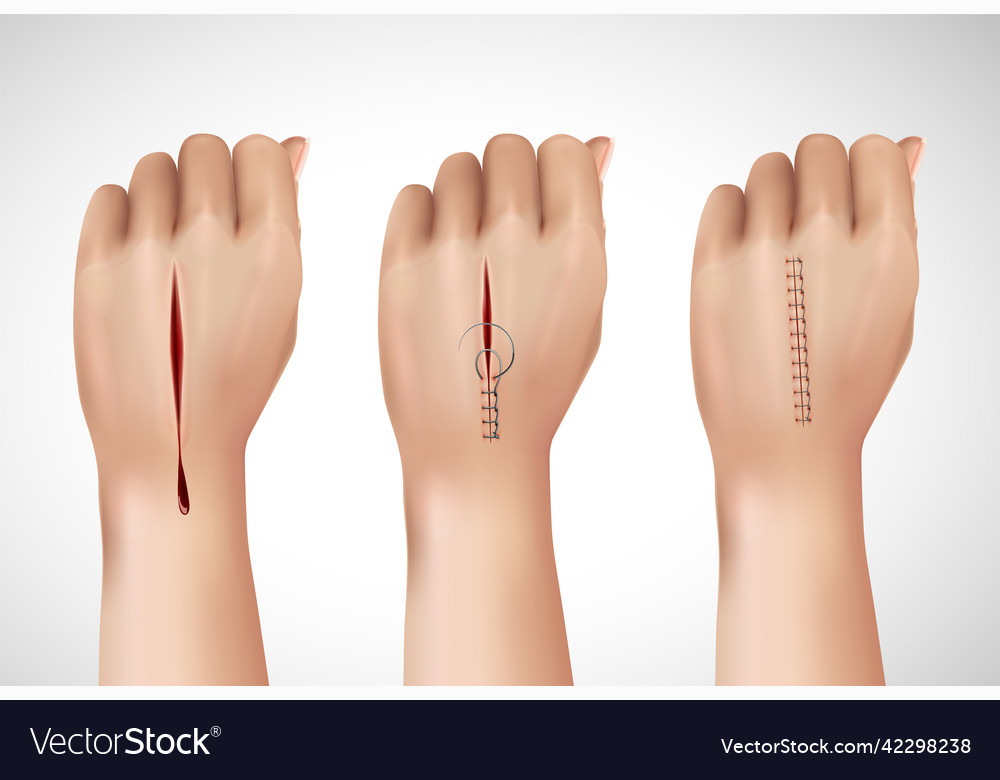 Surgical Stitching Hands Composition Royalty Free Vector