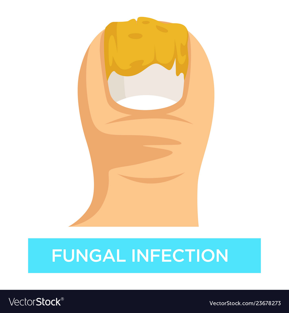 Fungal infection toenail damage suppuration toe Vector Image