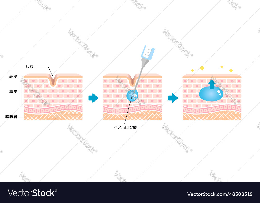 Mechanism of hyaluronic acid injection