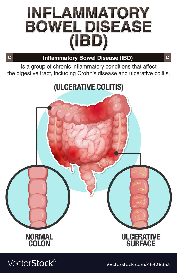 Inflammatory bowel disease ibd infographic Vector Image