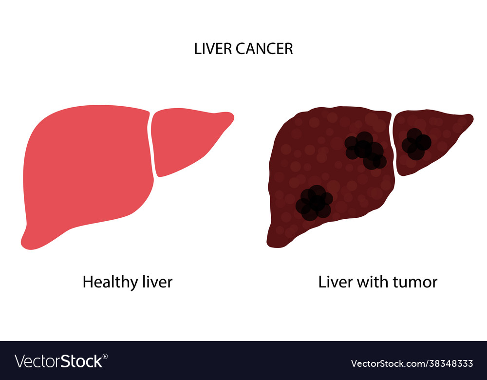 Liver disease concept Royalty Free Vector Image