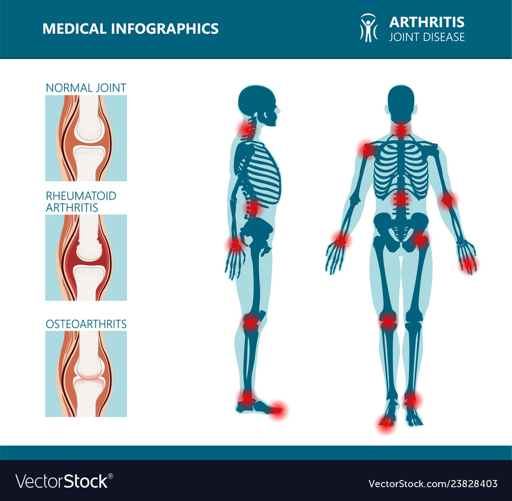 Rheumatism or rheumatic disorder medical posters