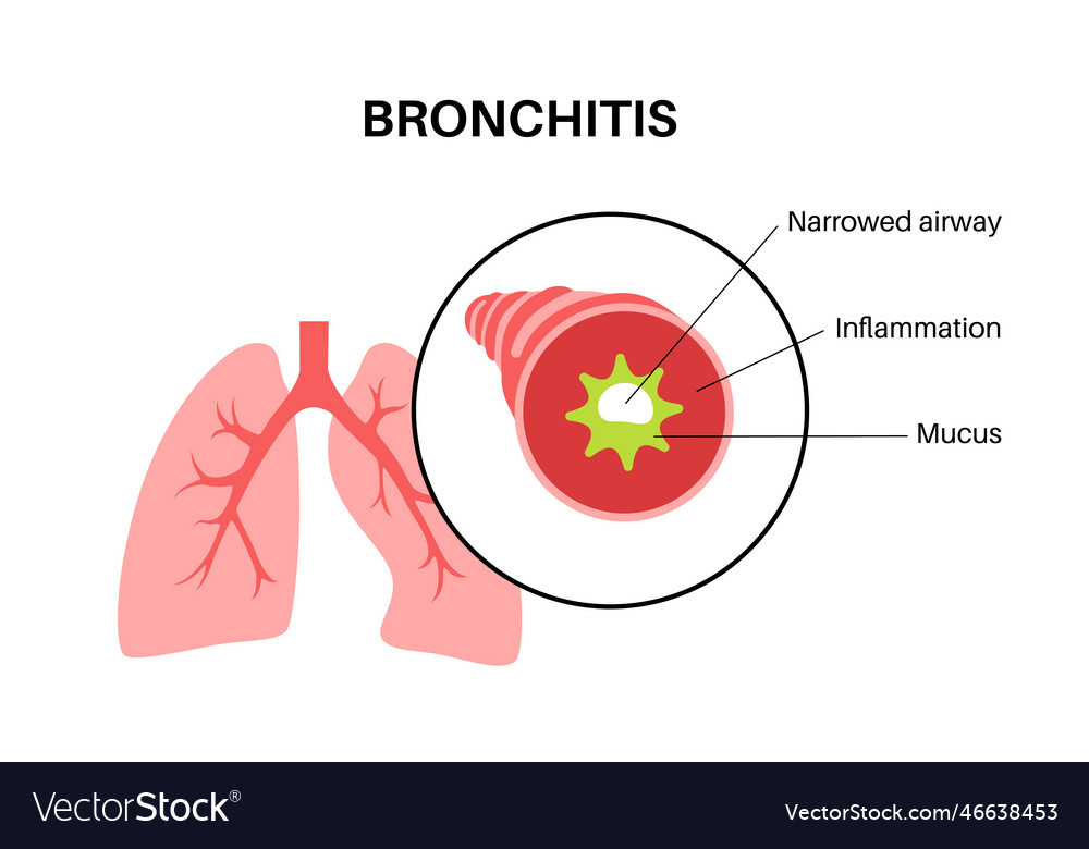 Bronchitis lung disease Royalty Free Vector Image