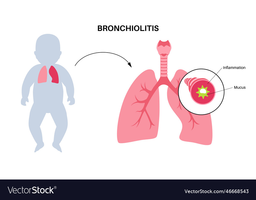 Bronchiolitis lung disease