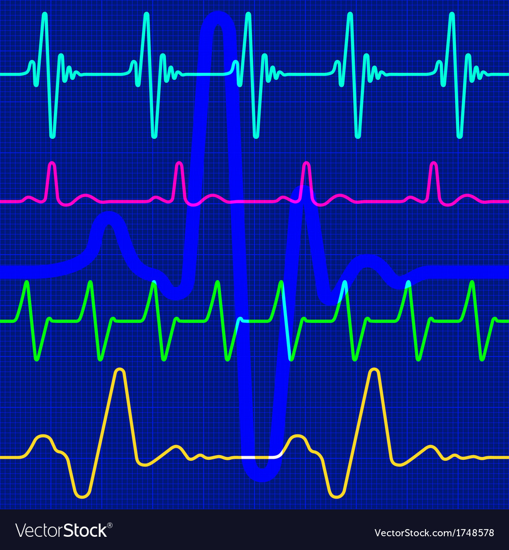 Cardiac Waveforms - ECG Patterns