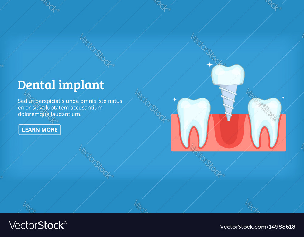 Dental Implant Banner Horizontal Cartoon Style Vector Image