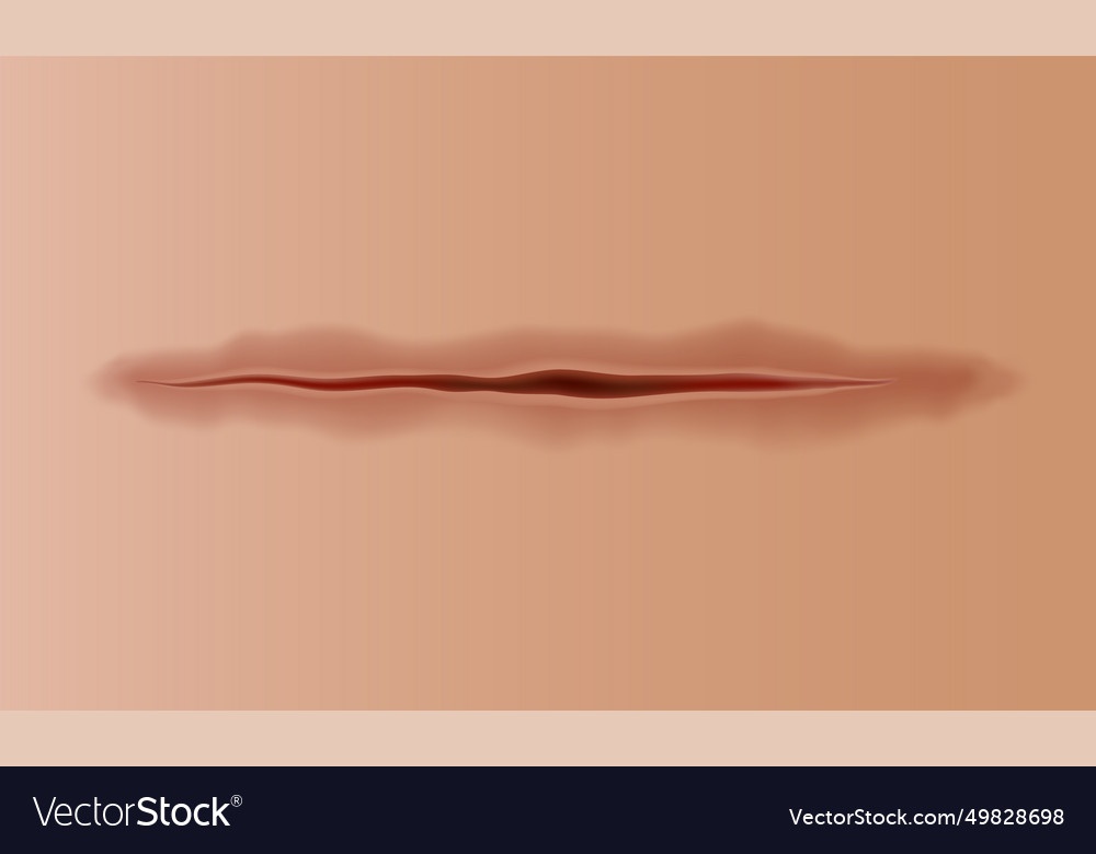 Healing wounds skin scar stitched gash and cut Vector Image
