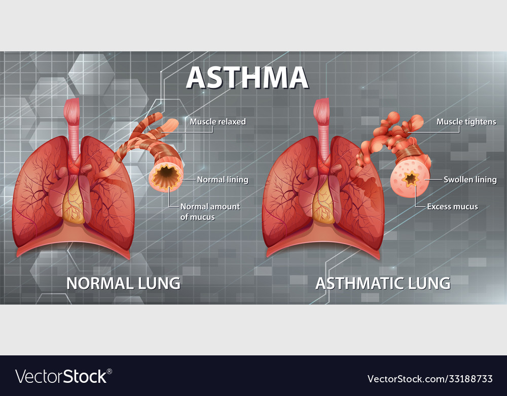 Human Anatomy Asthma Diagram Royalty Free Vector Image