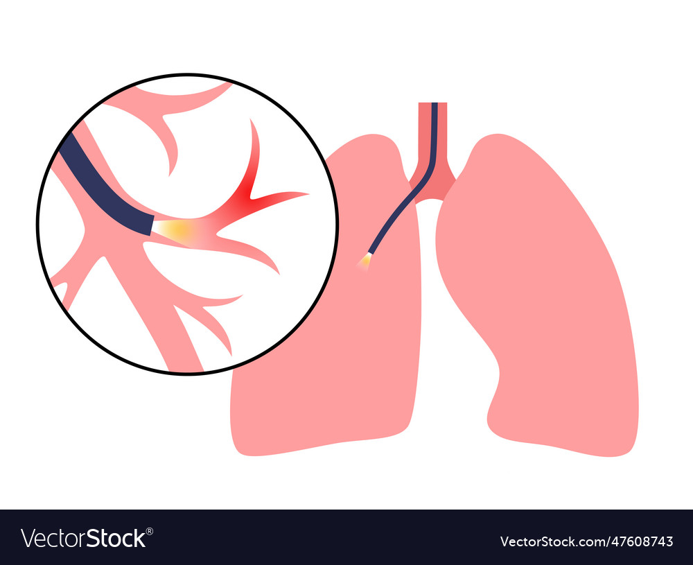 Bronchoscopy procedure concept Royalty Free Vector Image