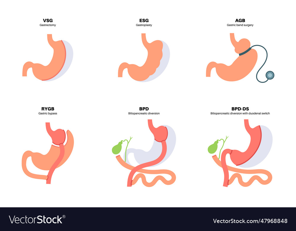 Bariatric surgery poster Royalty Free Vector Image