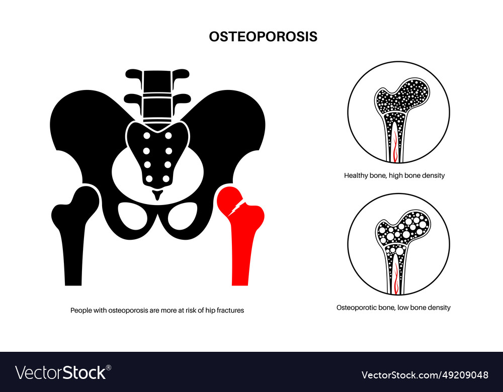 Osteoporosis medical poster Royalty Free Vector Image