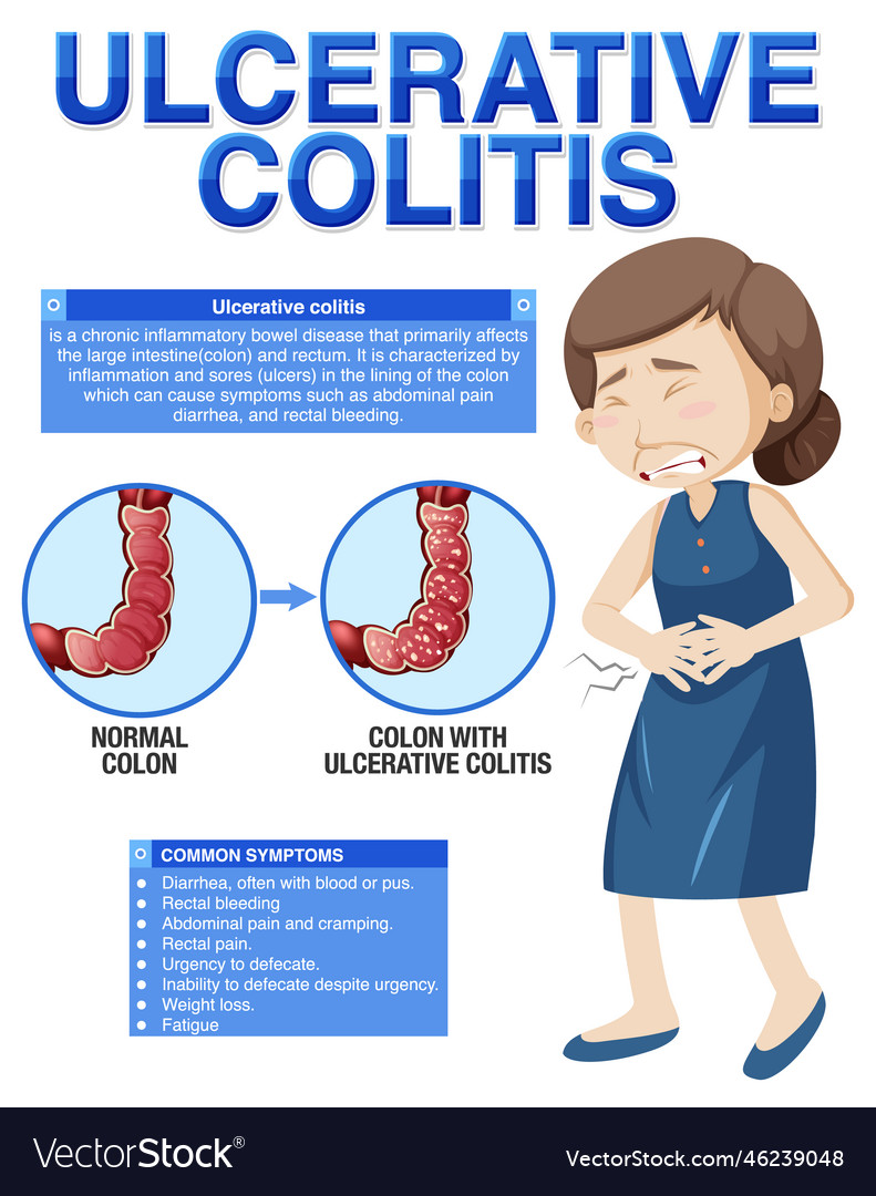 Ulcerative Colitis Symptoms Infographic Royalty Free Vector