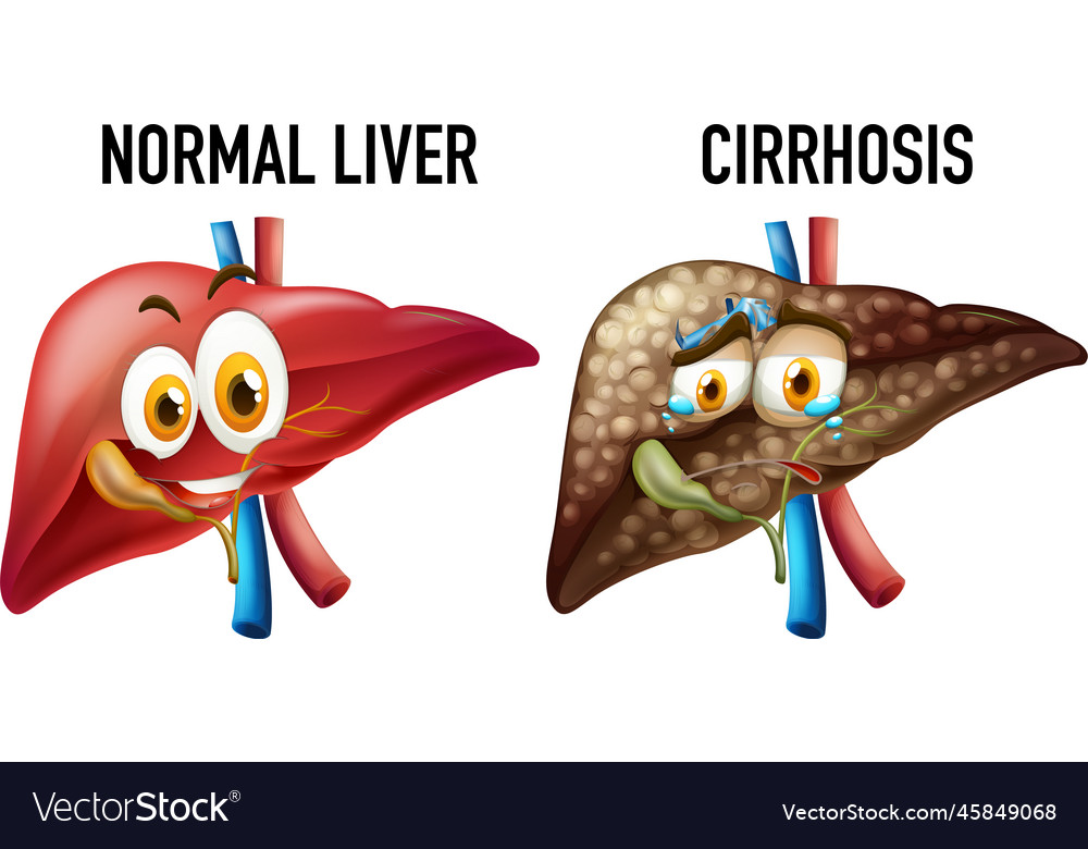 Normal Liver And Cirrhosis Royalty Free Vector Image